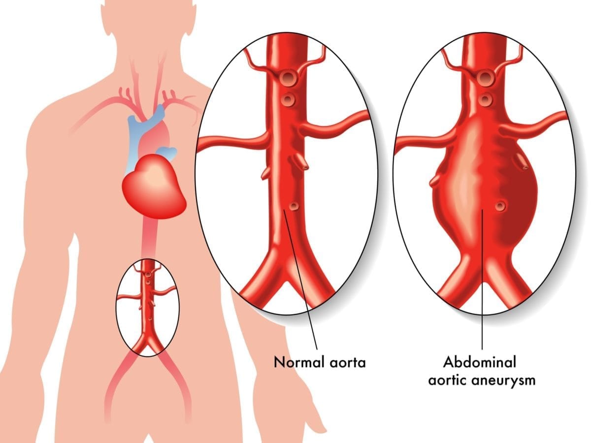 Qué es un aneurisma de aorta abdominal y cuáles son sus síntomas
