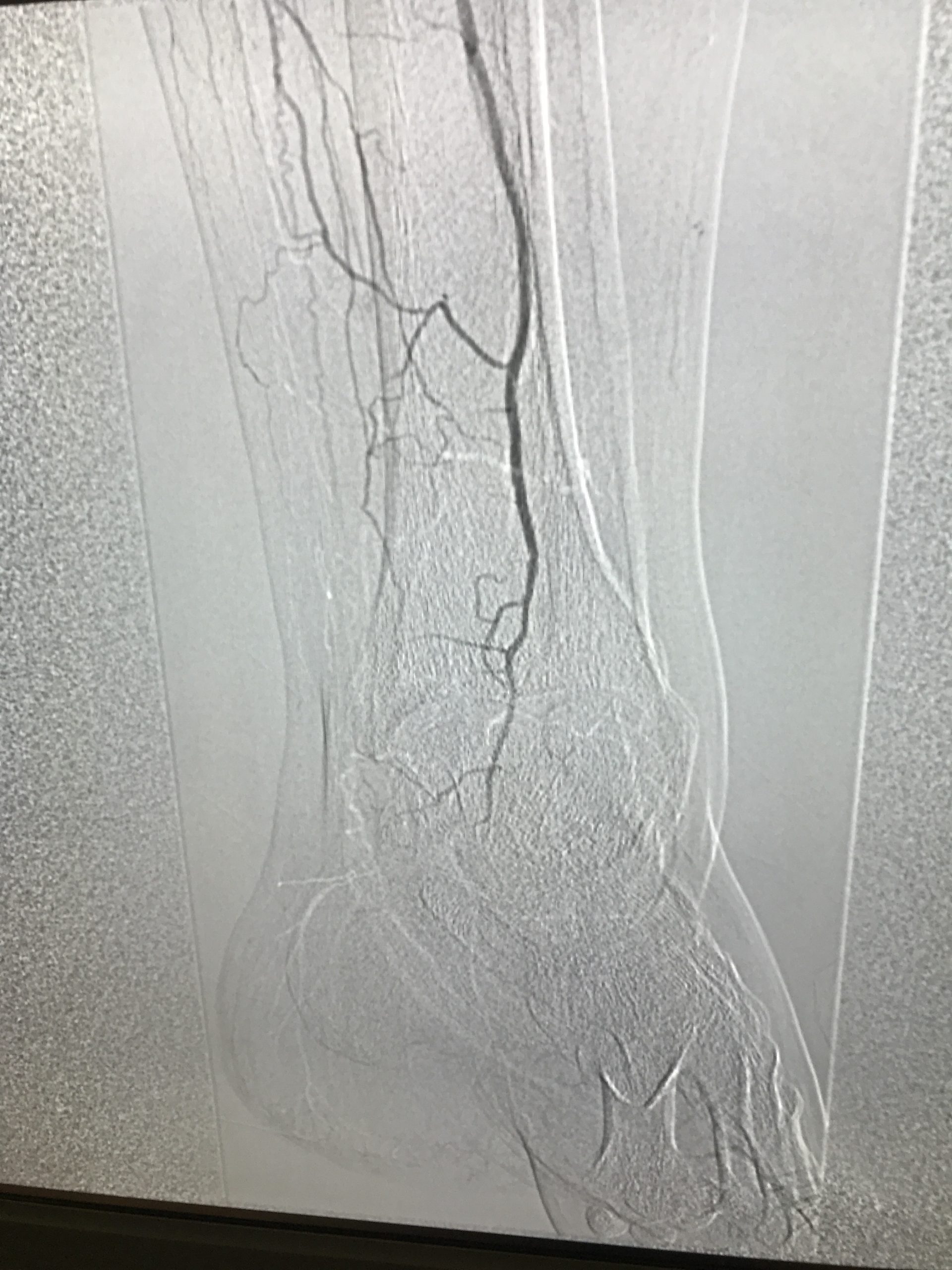 Qué papel tiene el Cirujano vascular en el pie diabético Doctora María Luisa Robles Martín