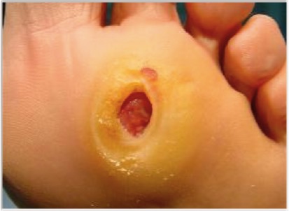 Cuáles son las úlceras más frecuentes del pie diabético