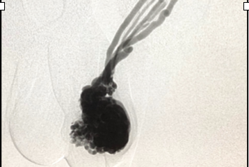 Cómo tratamos los Angiólogos y Cirujanos Vasculares el Varicocele testicular