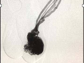 Cómo tratamos los Angiólogos y Cirujanos Vasculares el Varicocele testicular