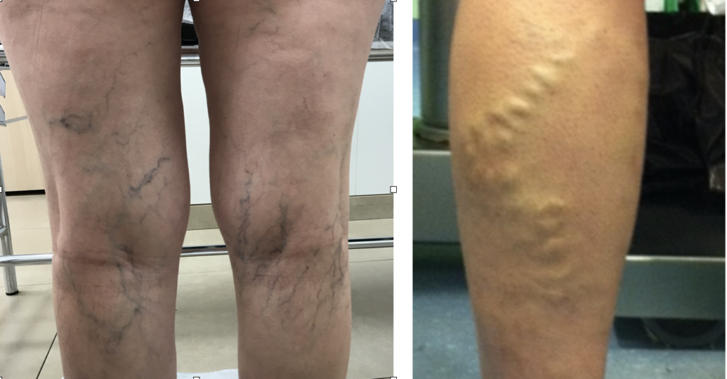 Tengo varices, ¿debería acudir a un Cirujano vascular?